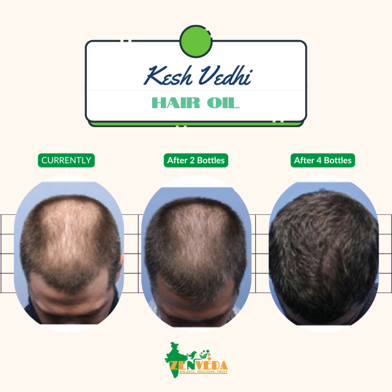 Kesh Vidhi Regrowth Hair Oil Before and After Use Showcase