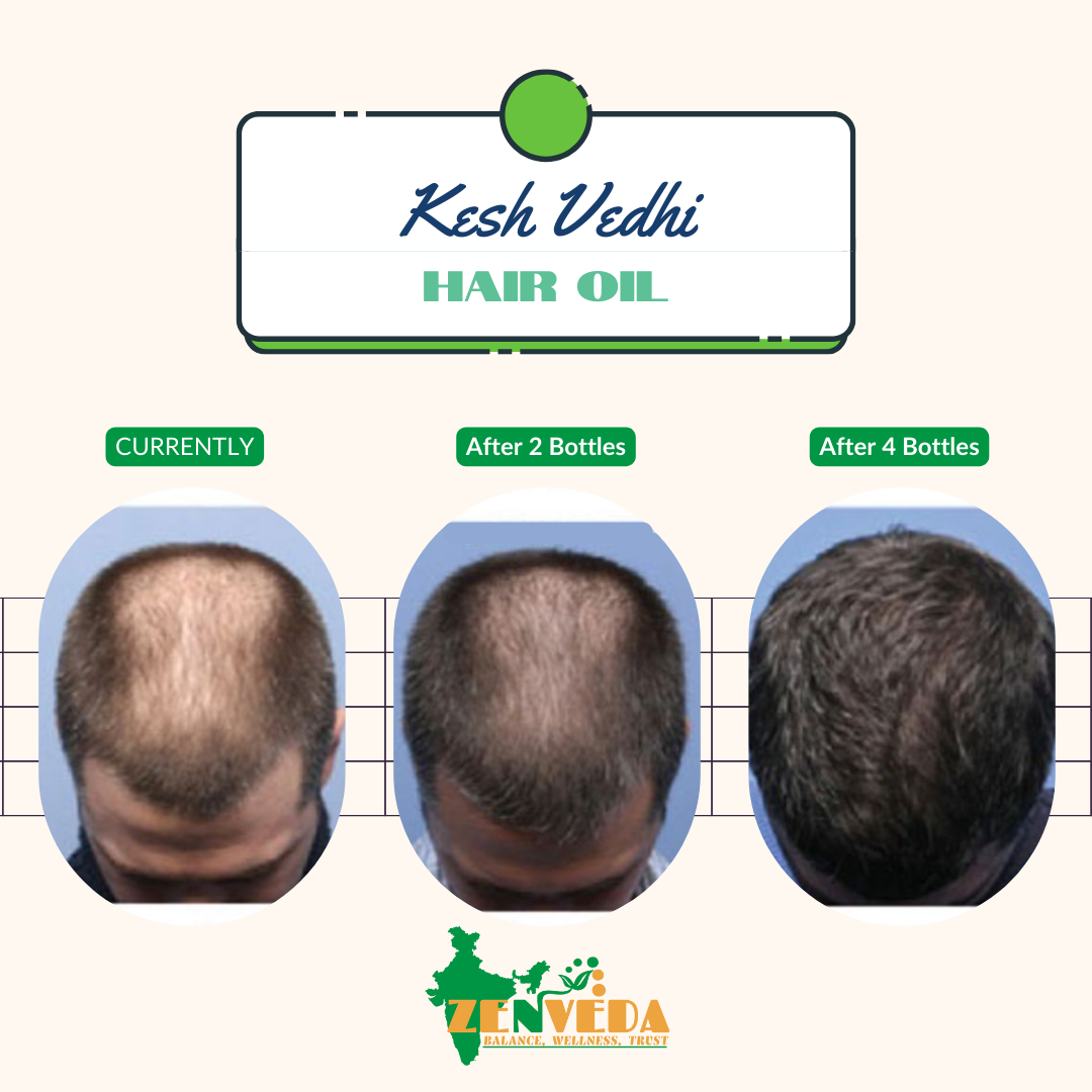 zen veda kesh vidhi regrowth hair oil before and after results